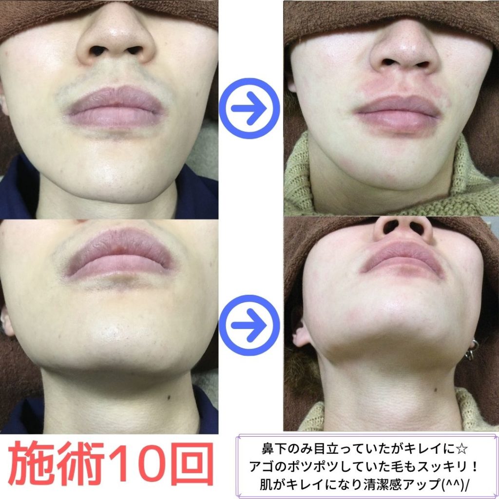 湯澤様　ヒゲ脱毛の変化　